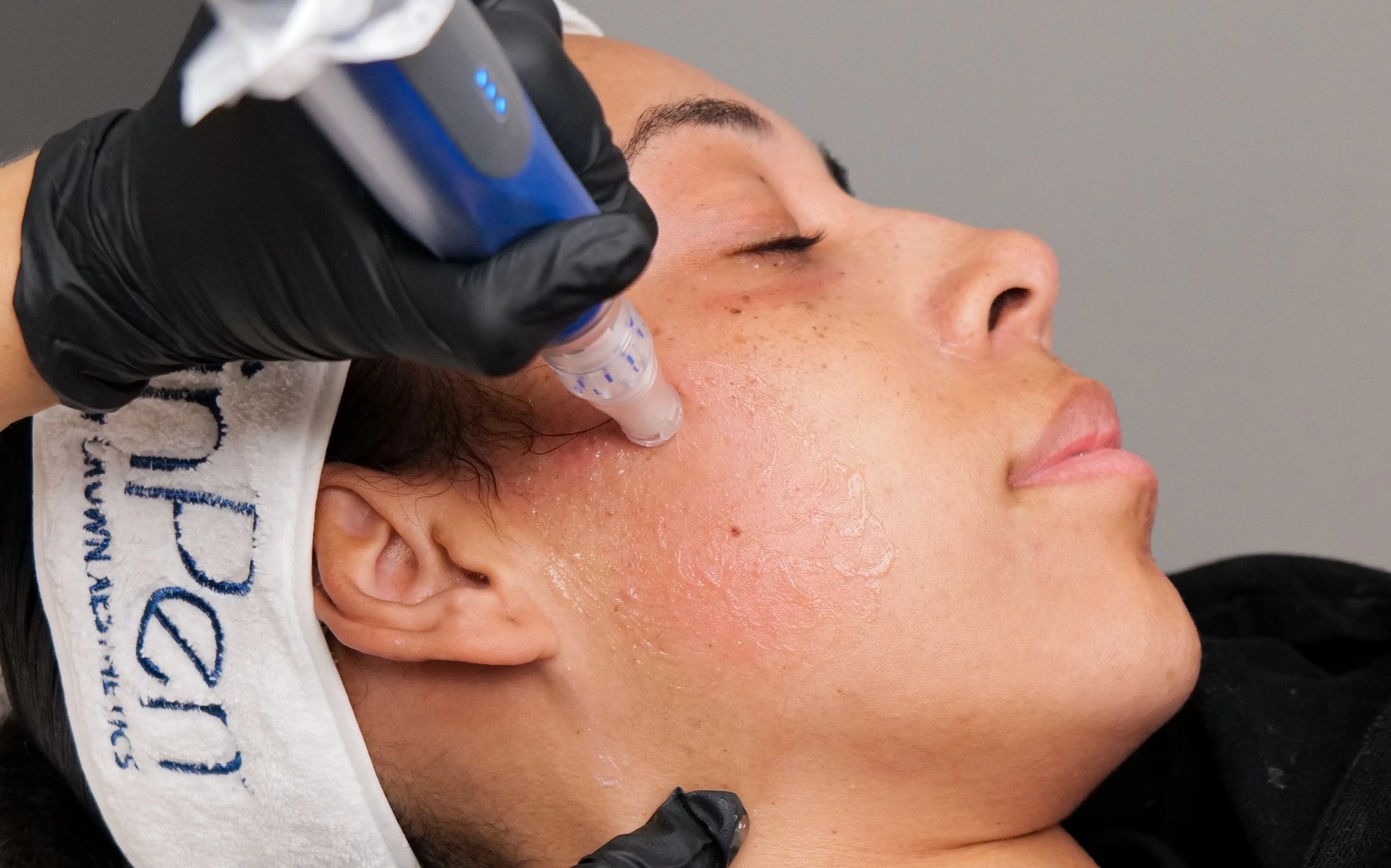 Microneedling